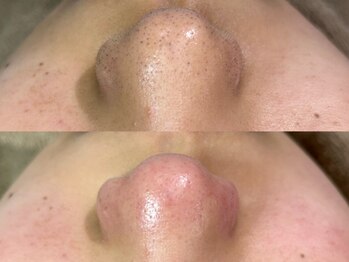 ニコ(Nico)の写真/【毛穴の黒ずみを取りたい方必見◎】毛穴エクストラクション+引き締め&美容導入¥9,000[谷町六丁目/毛穴]