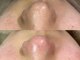 ニコ(Nico)の写真/【毛穴の黒ずみを取りたい方必見◎】毛穴エクストラクション+引き締め&美容導入¥9,000[谷町六丁目/毛穴]