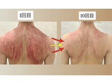 アグレーブル(Agreable)の雰囲気（スライドカッピング療法で慢性こり、老廃物脂肪分解を促します♪）