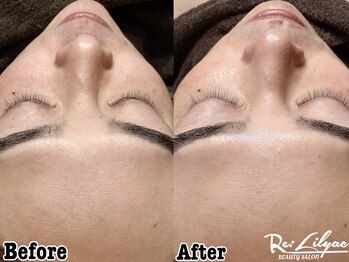 リリアック(Re:Lilyac)/Re:ilyac#顔脱毛#男性脱毛