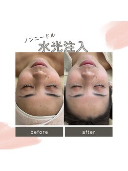 マヴィ 香里園店(MavY.)/ノンニードル水光注入！