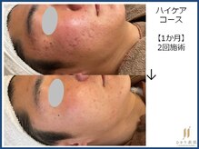 ひかり素肌/ハイケアコース 1か月