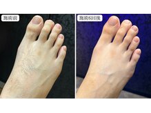 トパーズ 藤枝店(Topaz)/足の指.甲脱毛 藤枝/焼津/島田
