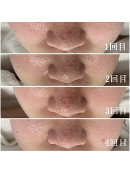 プラセル(Placer)/変わらなかった毛穴が少しずつ1