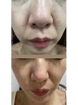 ブルーム(BL∞M)/ホームケアの結果