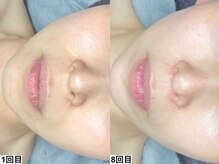 アンドミー 横浜(&me)/肌負担の少ない最新ピーリング