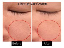 ナチュラーレ 梅田店(Naturale)/美肌ニキビケア小顔フェイシャル