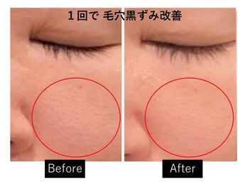 ナチュラーレ 梅田店(Naturale)/美肌ニキビケア小顔フェイシャル