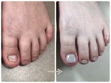 ネイルズシアム/フット深爪矯正