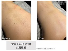 キャンアイドレッシー 東鷲宮店/初回レディース　背中全体