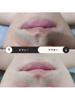 ジュゴン(Dugong)/ひげ脱毛（Before＆After）