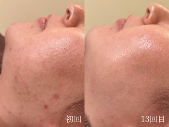 ウォーム(warm)/肌質改善/岡山/フェイシャル