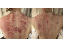 ギフト(GIFT)の雰囲気（かっさ施術2回目、2週に1度の変化。肩と腰のラインがスッキリ！）