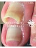 【5名様限定モニター募集】食い込む巻き爪を徹底ケア※事前確認撮影条件あり