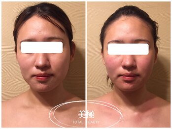 美極 トータルビューティー(美極 TOTAL BEAUTY)/恵比寿/小顔コルギ/エステ