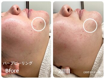 ラウレア(LAULEA)/ハーブピーリングBefore/After