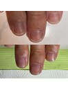 爪の剥離/角質増殖/爪の形