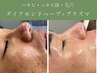 【剥離なし】ダイヤモンドハーブピーリング＋プラズマ　¥14,000