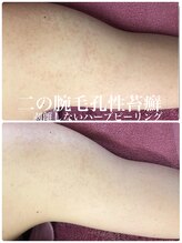 リリアーナ(LILIANA)/ハーブピーリングで二の腕ケア