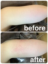 ギンザアール(GINZA R.)/二の腕に徹底アプローチ◎