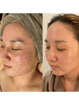 クレセント(CRESCENT)/ハーブピーリング×光フォト