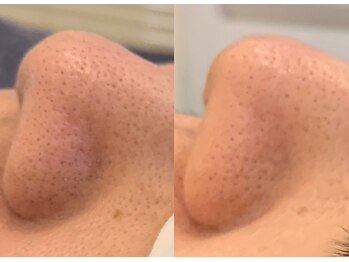 レペリオビューティーサロン(reperio beauty salon)の写真/【毛穴レスな陶器肌へ】ガンコな黒ずみや開きを徹底ケア！プロの毛穴洗浄＆マッサージでつるんとなめらか肌