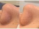レペリオビューティーサロン(reperio beauty salon)の写真/【毛穴レスな陶器肌へ】ガンコな黒ずみや開きを徹底ケア！プロの毛穴洗浄＆マッサージでつるんとなめらか肌