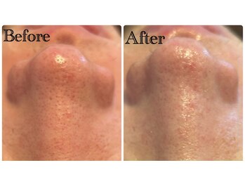 グラサヴォーグ 金沢店/黒ずみ徹底ケア