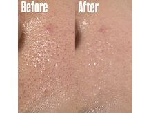 ベル(Belle)/毛穴ケア