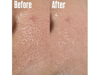 ベル(Belle)/毛穴ケア