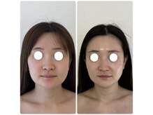 アンドモア(&more)/小顔症例