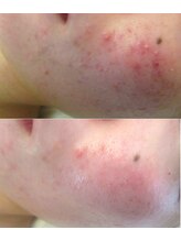 サロンドエステケイワイ(de KY)/フェイシャル施術１回ニキビ改善