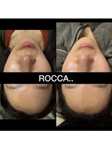 ロッカ(ROCCA..)/ハーブピーリング