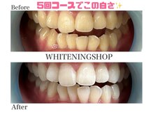 ホワイトニングショップ 名古屋店/【ビフォーアフター】5回コース