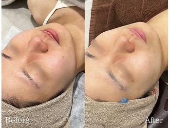 TD 鵜沼店/ハーブピーリング