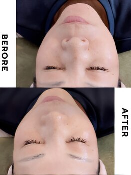 リナ(RINA)/切らない糸リフトUP