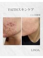 リノアドット(LiNOA.)&nbsp;お肌悩み（ニキビ・しみ等）に合わせて、ご提案いたします。