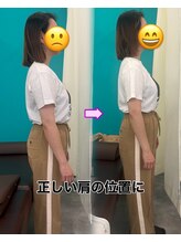 西宮ヤノ整骨院/骨盤矯正で反り腰/巻き肩を改善