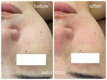 サロンディト(ditto)/【施術1回】マーメイドセル