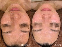 ビューティ ワンド ユズ(Beauty Wand YUZZ)/オーダーメイドケア　６回