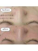 ケアプラス/毛穴縮小