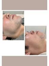 ミセレルオカザキ(MISEREL OKAZAKI)/髭脱毛