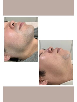 ミセレルオカザキ(MISEREL OKAZAKI)/髭脱毛