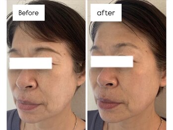 リノ(LINO)/たるみケアはLINOにおまかせ◎