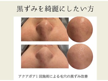 BUB 立川/黒ずみスッキリしたい方へ