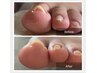 【巻き爪・片足1本】　