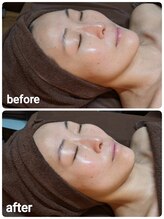 ウララ(ulala)/セラピールビフォアフ