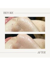ルアナ(LUANA。)/毛穴洗浄☆ビフォーアフター
