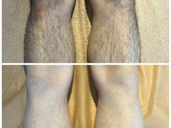 ヨリ(yori)/脱毛2回。劇的ビフォアフ！