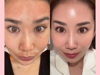 ウィズルーチェ 麻布十番店(with luce)/オーナーの劇的肌変化♪　